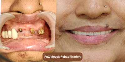 Full Mouth Rehabilitation at The Orchid Dental Clinic in New Delhi